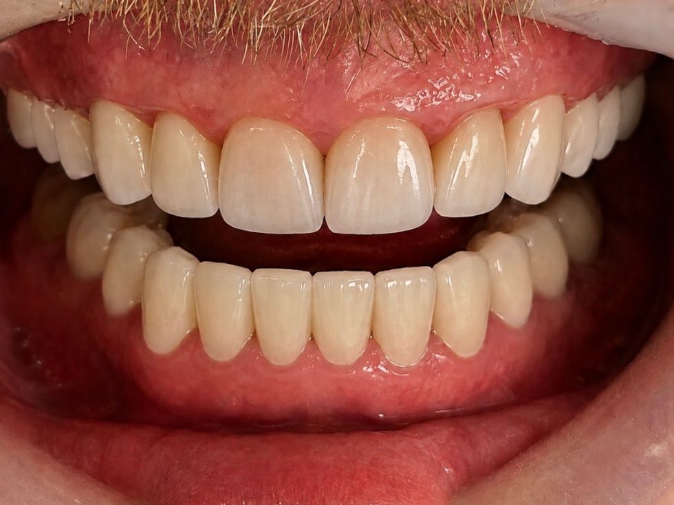 Smile after full redesign with porcelain veneers.
