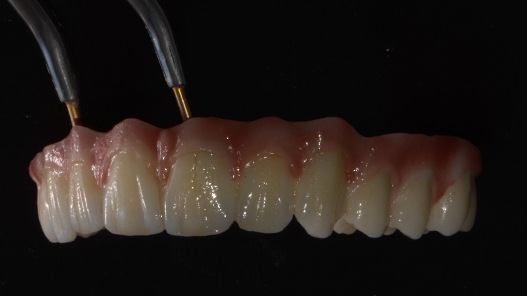 Natural looking full arch of teeth, made out of zirconia.