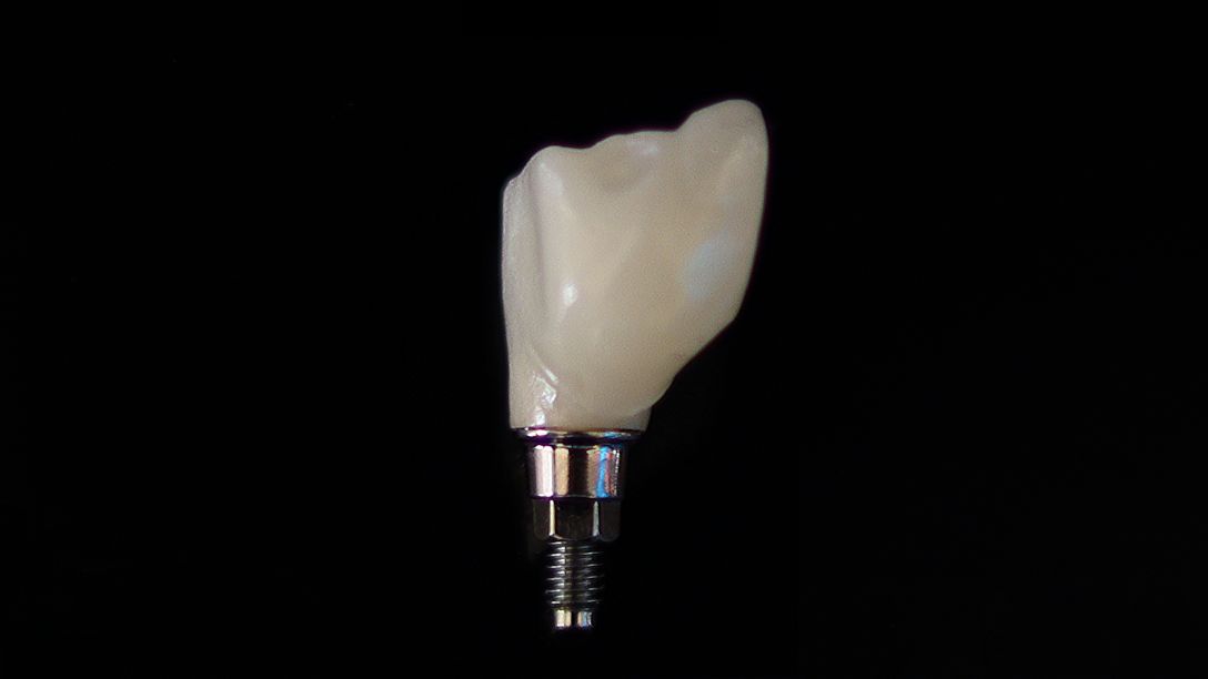 Natural looking full arch of teeth, made out of zirconia.