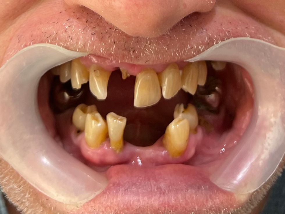 Smile before treatment.