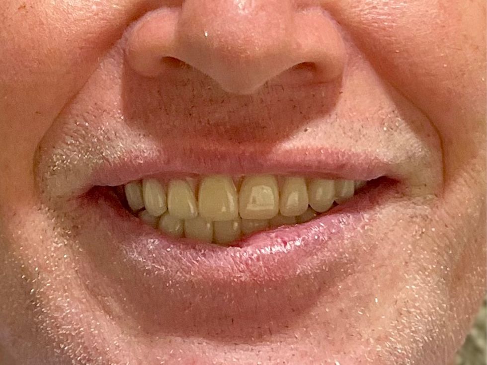 Smile after treatment.