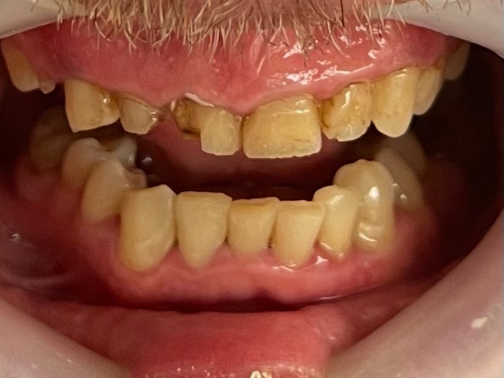 Smile before treatment.